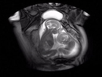bebek-ikiz.jpg