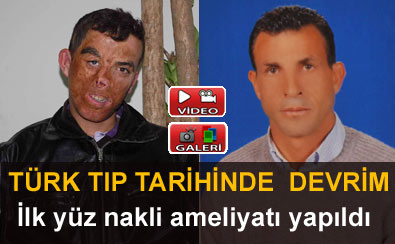 T�rkiye'de �lk y�z nakli ger�ekle�tirildi
